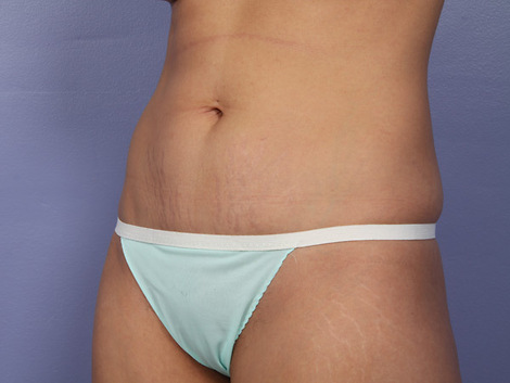 Tummy Tuck before and after photo