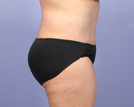 Tummy Tuck before and after photo