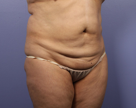 Tummy Tuck before and after photo