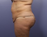 Tummy Tuck Before and after photo