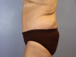 Tummy Tuck Before and after photo