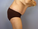 Tummy Tuck Before and after photo