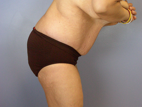 Tummy Tuck before and after photo