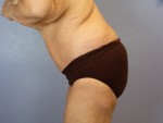 Tummy Tuck Before and after photo