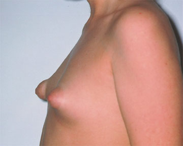 Breast Augmentation before and after photo