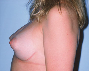 Breast Augmentation before and after photo