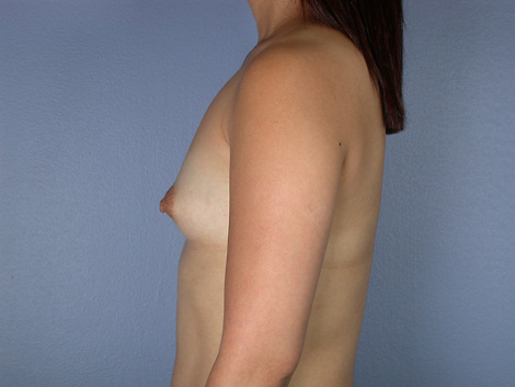 Breast Augmentation before and after photo