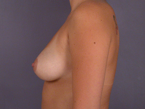 Breast Augmentation before and after photo