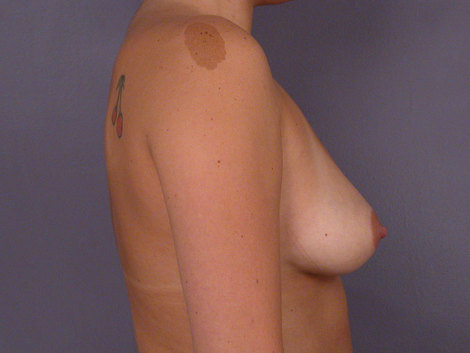 Breast Augmentation before and after photo