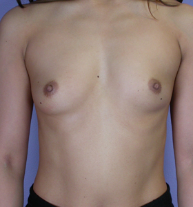 Breast Augmentation before and after photo