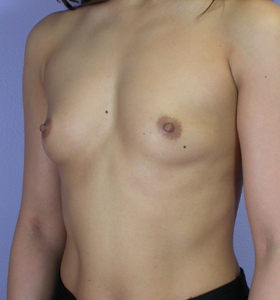 Breast Augmentation before and after photo