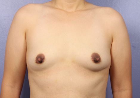 Breast Augmentation before and after photo