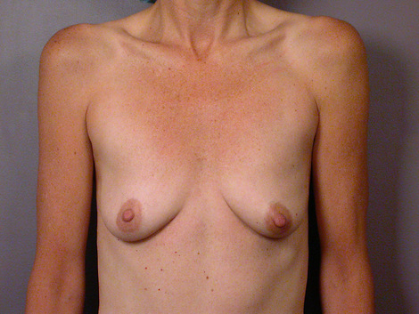 Breast Augmentation before and after photo