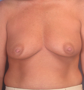 Breast Augmentation before and after photo