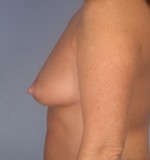 Breast Augmentation Before and after photo