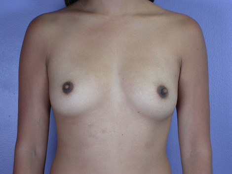 Breast Augmentation before and after photo