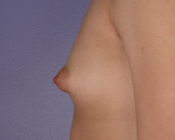 Breast Augmentation before and after photo