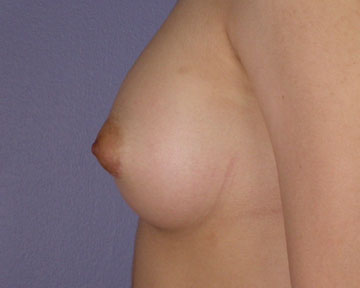 Breast Augmentation before and after photo