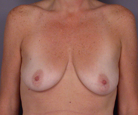 Breast Augmentation before and after photo