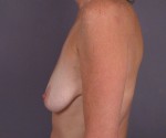 Breast Augmentation Before and after photo