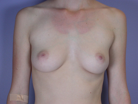 Breast Augmentation before and after photo