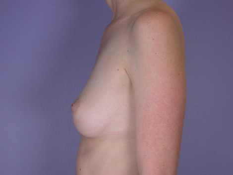 Breast Augmentation before and after photo