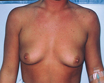 Breast Augmentation before and after photo