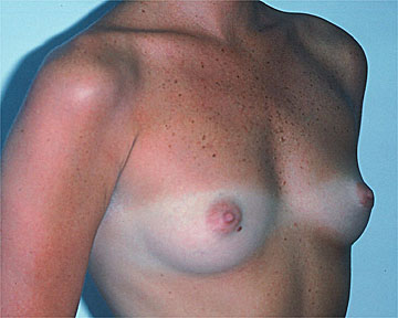 Breast Augmentation before and after photo