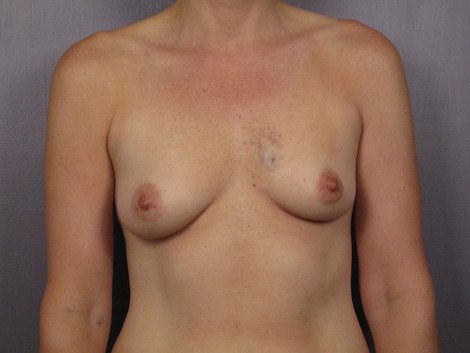 Breast Augmentation before and after photo