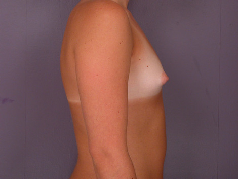 Breast Augmentation before and after photo