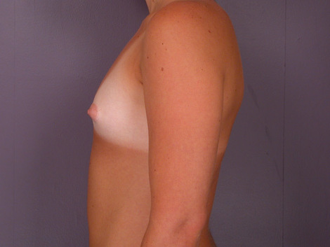 Breast Augmentation before and after photo