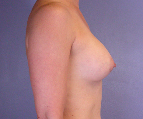 Breast Augmentation before and after photo