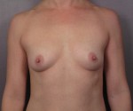 Breast Augmentation