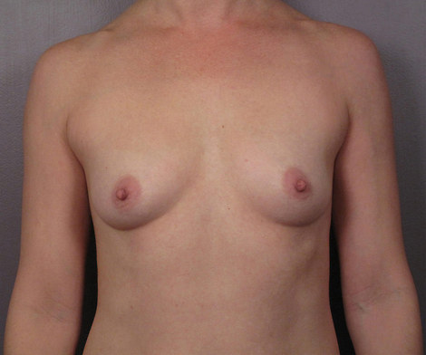 Breast Augmentation before and after photo