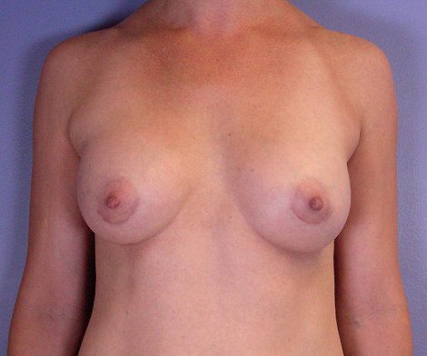 Breast Augmentation before and after photo