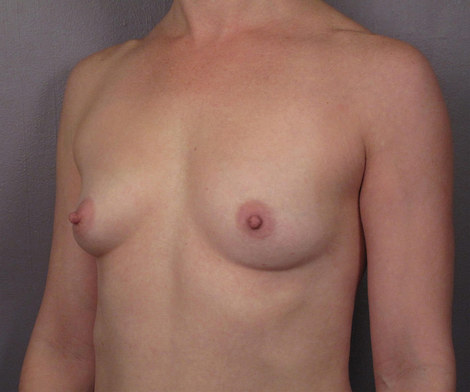 Breast Augmentation before and after photo