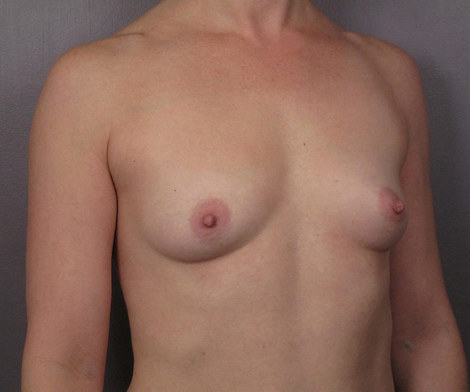 Breast Augmentation before and after photo