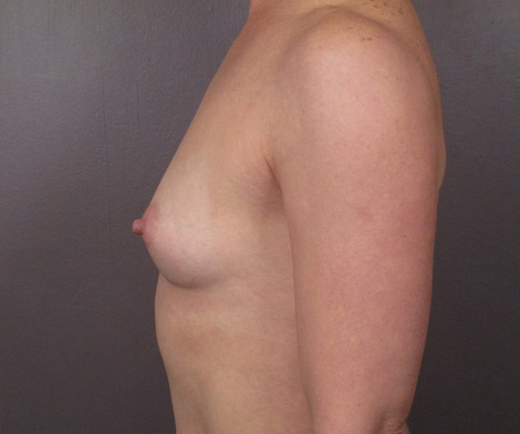 Breast Augmentation before and after photo