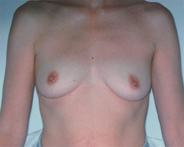 Breast Augmentation before and after photo