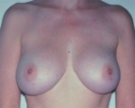 Breast Augmentation