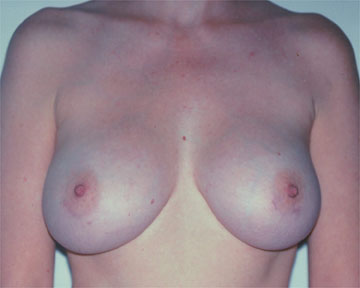 Breast Augmentation before and after photo