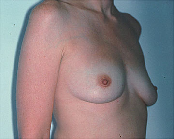 Breast Augmentation before and after photo