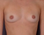 Breast Augmentation