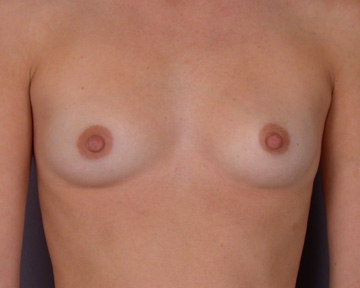 Breast Augmentation before and after photo