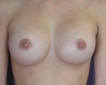 Breast Augmentation