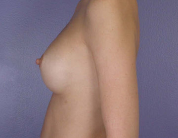 Breast Augmentation before and after photo