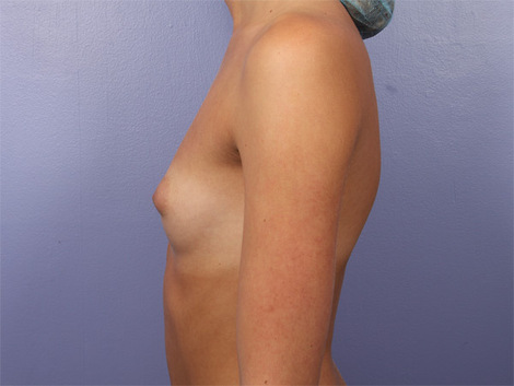 Breast Augmentation before and after photo