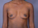 Breast Augmentation