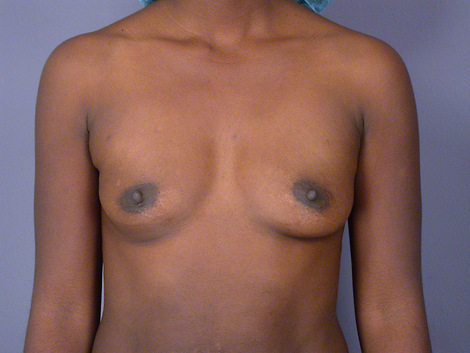 Breast Augmentation before and after photo