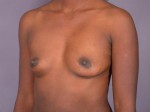 Breast Augmentation Before and after photo